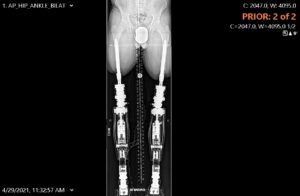 osseointegration-xray